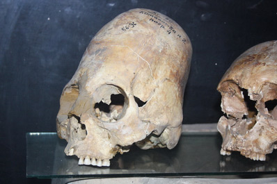 Elongated Skull Excavated in Samarkand, 600-800 CE, Afrasiab Museum, Samarkand